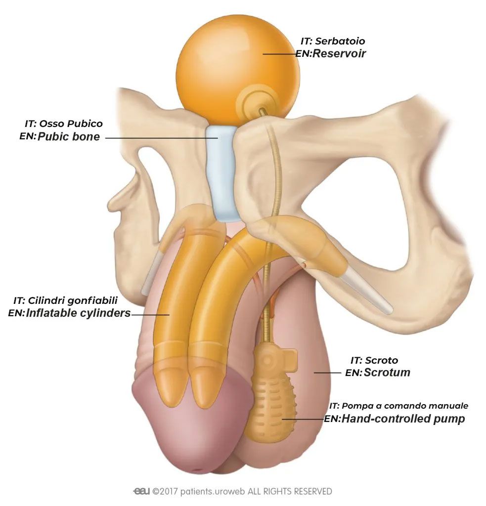Fig. 1: Un tipo comune di impianto penieno gonfiabile.